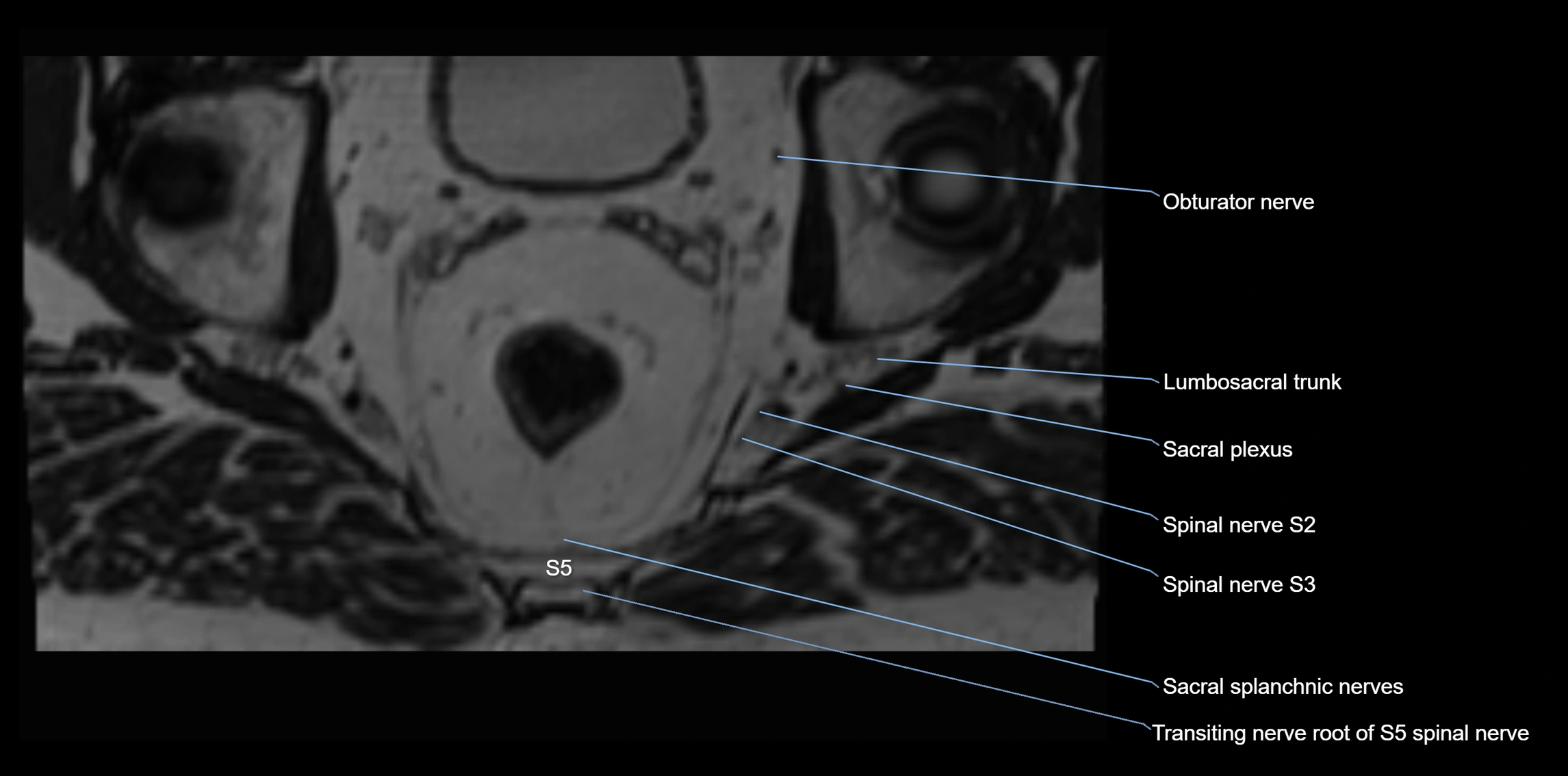 MR lumbosacral plexus axial cross sectional anatomy 3T  radiology  image-img-1008001-00111.webp